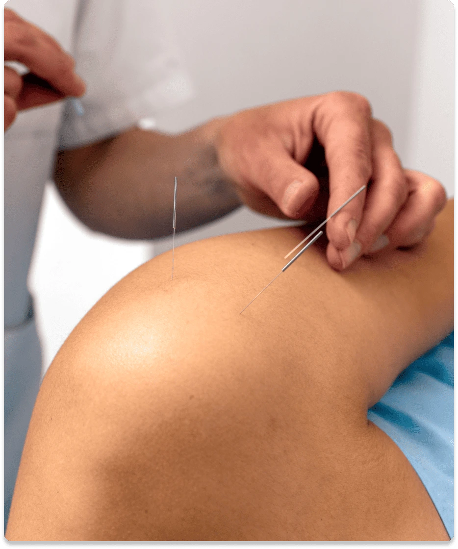 Acupuncture treatment